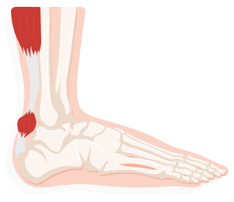 Achilles Tendonitis