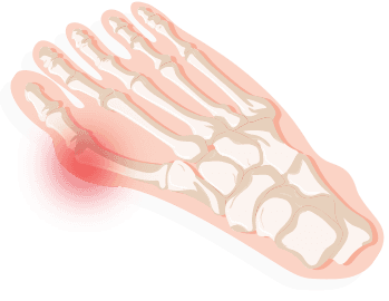 big toe and heel pain