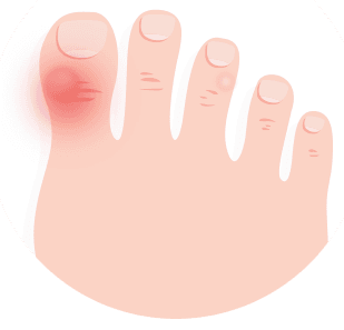 sharp pain in callus on foot