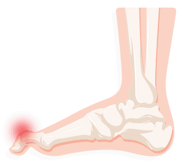 sharp pain in callus on foot