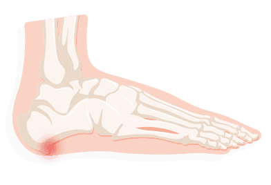 sudden sharp shooting pain in heel