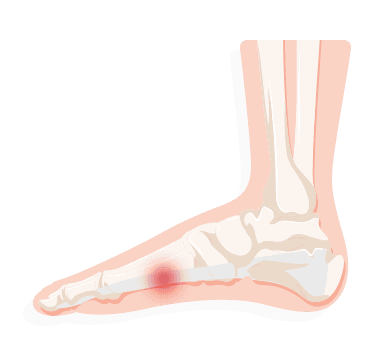 stabbing pain in arch of foot