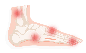 tendonitis bottom of foot