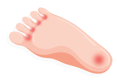 sore spot on sole of foot